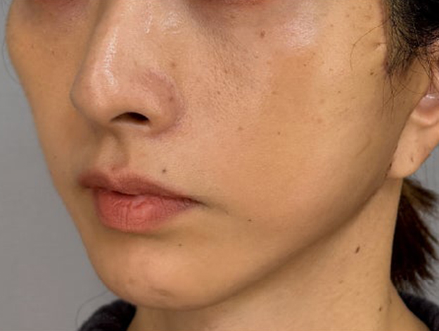 症例写真,フェイスリフトで顔のボリュームを整えた術後1ヶ月の症例写真,1ヶ月後,mainpic_facelift012e.jpg