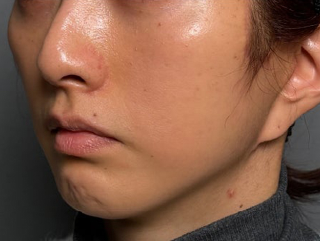 症例写真,フェイスリフトで顔のボリュームを整えた術後1ヶ月の症例写真,3ヶ月後,mainpic_facelift012f.jpg