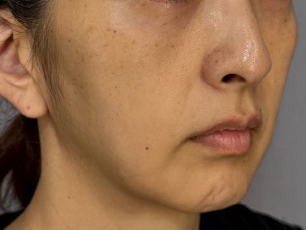 症例写真,フェイスリフトで顔のボリュームを整えた術後1ヶ月の症例写真,施術前,mainpic_facelift012g.jpg