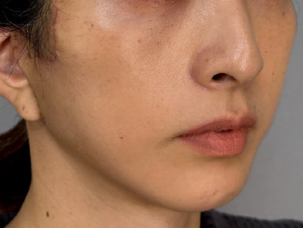 症例写真,フェイスリフトで顔のボリュームを整えた術後1ヶ月の症例写真,1ヶ月後,mainpic_facelift012h.jpg
