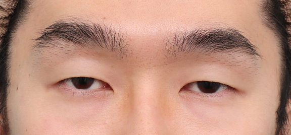 連続埋没法で奥二重にした症例写真,Before,ba_maibotsu3006_b01.jpg