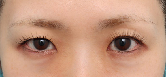 裏留め埋没法＋目頭切開で二重を形成した症例写真,Before,ba_maibotsu2015_b01.jpg