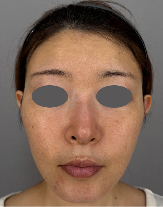 ミディアムフェイスリフト,ミディアムフェイスリフトを行った40代患者様の症例写真,After（3ヶ月後）,ba_mediumlift030_a01.jpg