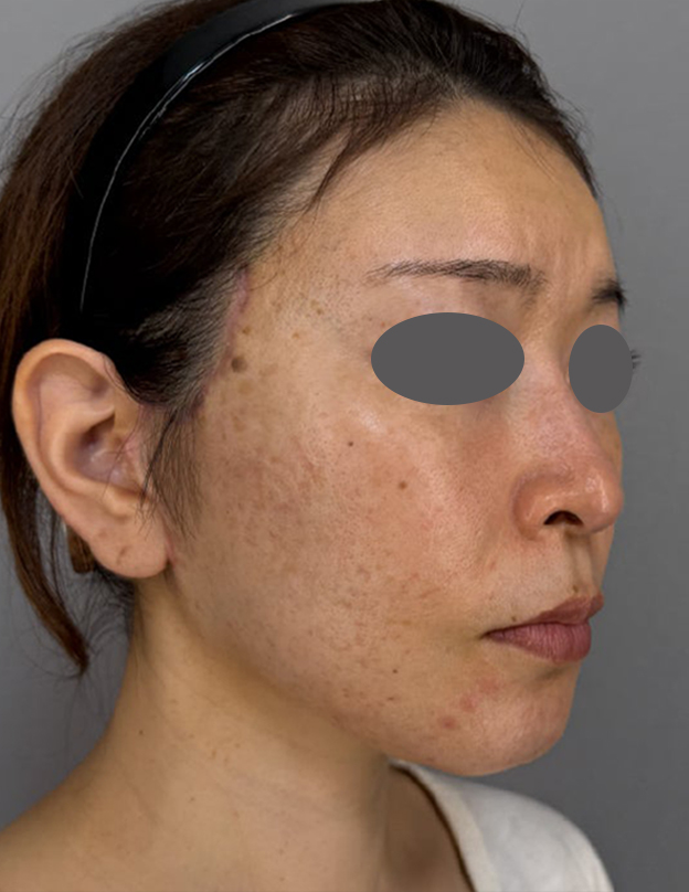 症例写真,ミディアムフェイスリフトを行った40代患者様の症例写真,After（3ヶ月後）,ba_mediumlift030_b02.jpg