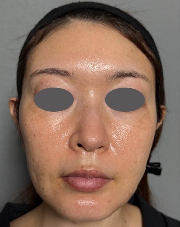 ミディアムフェイスリフト,ミディアムフェイスリフトを行った40代患者様の症例写真,Before,ba_mediumlift030_b01.jpg