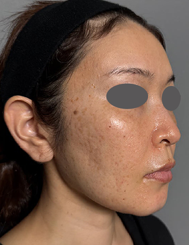 症例写真,ミディアムフェイスリフトを行った40代患者様の症例写真,Before,ba_mediumlift030_b02.jpg