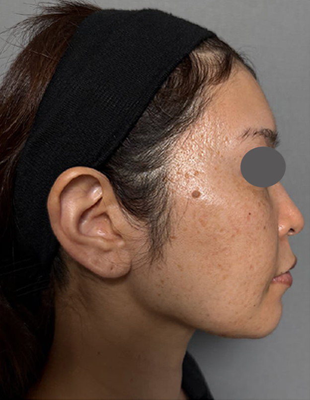 症例写真,ミディアムフェイスリフトを行った40代患者様の症例写真,Before,ba_mediumlift030_b03.jpg