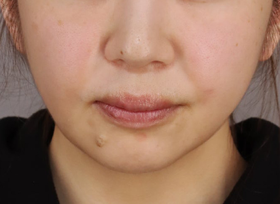 ミニフェイスリフトでしわやたるみを改善した症例写真,Before,ba_minilift032_b01.jpg