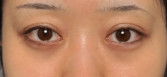 左目に二重まぶた・埋没法の二針固定と、目の下の切らない脂肪取りを行った20代患者様の症例写真,After（3ヶ月後）,ba_maibotsu096_a01.jpg