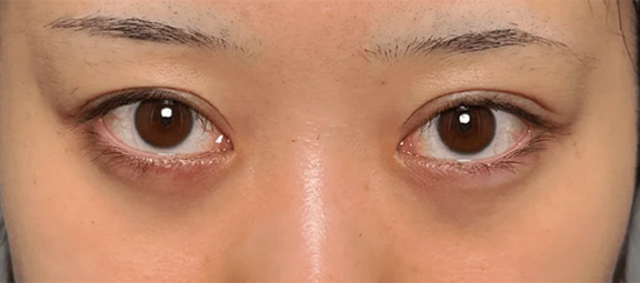 症例写真,左目に二重まぶた・埋没法の二針固定と、目の下の切らない脂肪取りを行った20代患者様の症例写真,After（3ヶ月後）,ba_maibotsu096_b02.jpg