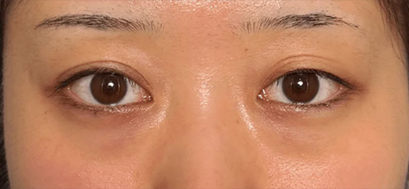左目に二重まぶた・埋没法の二針固定と、目の下の切らない脂肪取りを行った20代患者様の症例写真,Before,ba_maibotsu096_b01.jpg