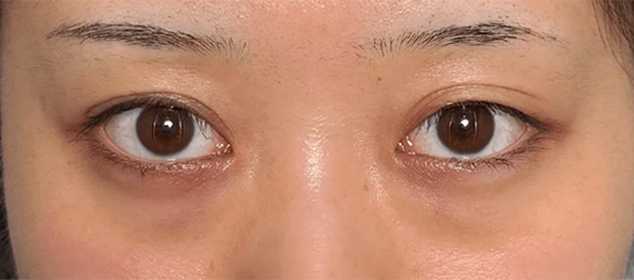 症例写真,左目に二重まぶた・埋没法の二針固定と、目の下の切らない脂肪取りを行った20代患者様の症例写真,Before,ba_maibotsu096_b02.jpg