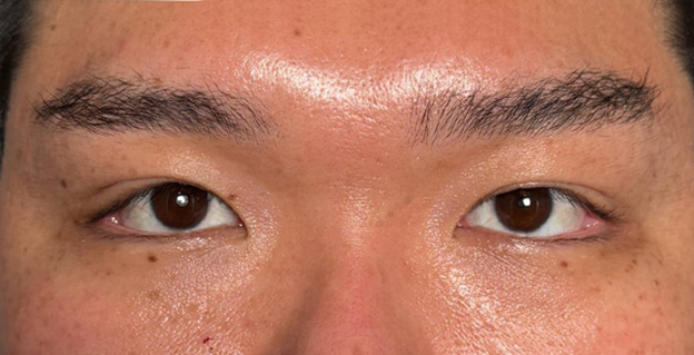 二重まぶた・全切開法でかなり重たい一重まぶたを二重にして目の開きを良くした症例写真,After（1ヶ月後）,ba_sekkai122_a01.jpg