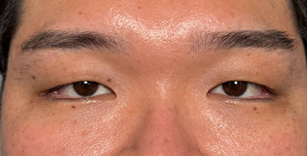 二重まぶた・全切開法でかなり重たい一重まぶたを二重にして目の開きを良くした症例写真,Before,ba_sekkai122_b01.jpg