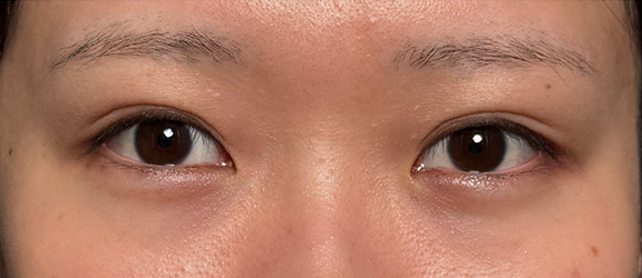 安定せずかぶれてしまっていたまぶたを二重まぶた・埋没法で整えた症例写真,After（3ヶ月後）,ba_maibotsu099_a01.jpg