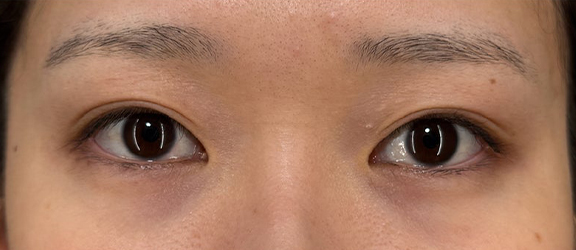 安定せずかぶれてしまっていたまぶたを二重まぶた・埋没法で整えた症例写真,Before,ba_maibotsu099_b01.jpg