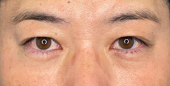目の下の脂肪取りで疲れて見える目元を改善した症例写真,After（6ヶ月後）,ba_shibo_under020_a01.jpg