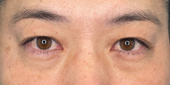 目の下の脂肪取りで疲れて見える目元を改善した症例写真,Before,ba_shibo_under020_b01.jpg