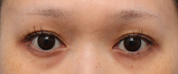 たるみで二重幅が狭くなった目を平行二重にした30代女性の症例写真,Before,ba_sekkai123_b01.jpg