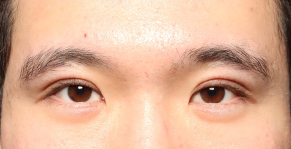 他院で受けた切開二重手術を修正した20代男性の症例写真,After（1ヶ月後）,ba_eye_modify026_a01.jpg
