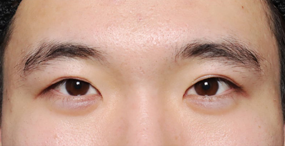 他院で受けた切開二重手術を修正した20代男性の症例写真,Before,ba_eye_modify026_b01.jpg