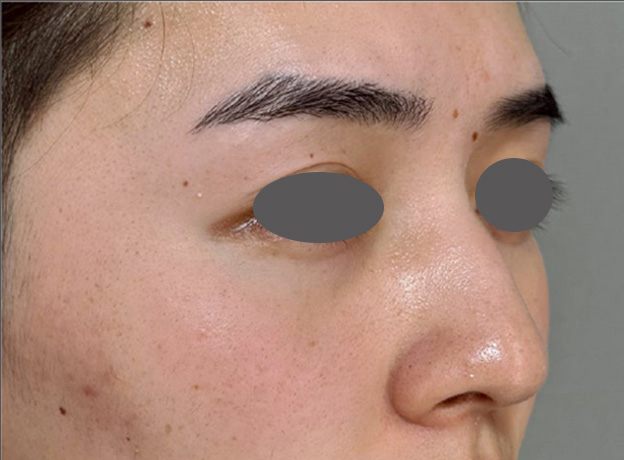 症例写真,斜鼻修正（曲がった鼻をまっすぐに）を行った20代男性の症例写真,After（3ヵ月後）,ba_shabi003_b02.jpg