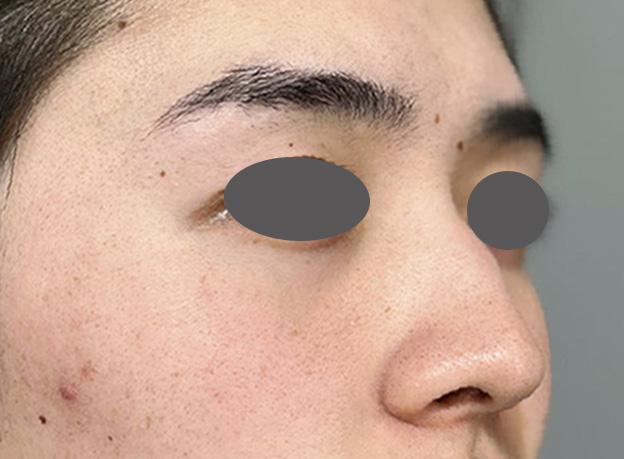 症例写真,斜鼻修正（曲がった鼻をまっすぐに）を行った20代男性の症例写真,Before,ba_shabi003_b02.jpg