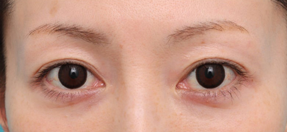 上まぶたのたるみを改善した30代の患者様の症例写真,Before,ba_jougankenlift017_b01.jpg
