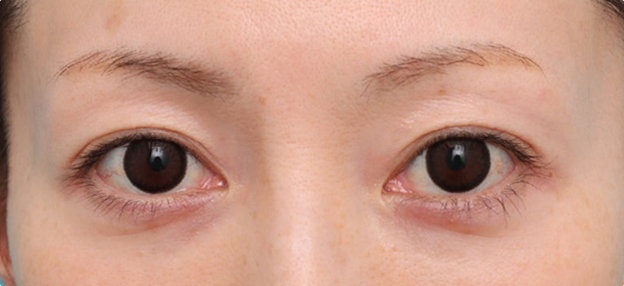症例写真,上まぶたのたるみを改善した30代の患者様の症例写真,施術前,mainpic_jougankenlift017a.jpg