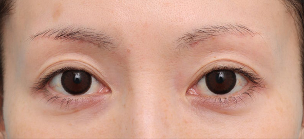 症例写真,上まぶたのたるみを改善した30代の患者様の症例写真,1ヶ月後,mainpic_jougankenlift017b.jpg
