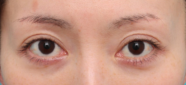 症例写真,上まぶたのたるみを改善した30代の患者様の症例写真,3ヶ月後,mainpic_jougankenlift017c.jpg
