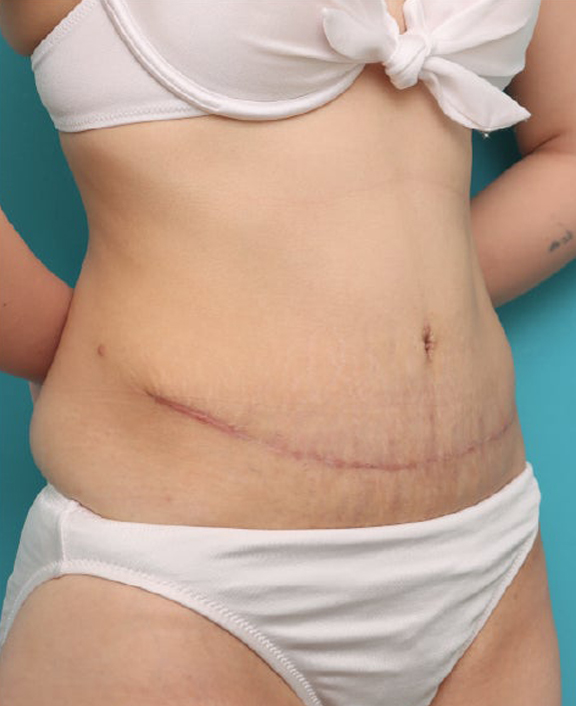 症例写真,腹リダクション（お腹のたるみ取り）手術で妊娠後のお腹のたるみを改善した20代女性の症例写真,After（6ヶ月後）,ba_hara003_b02.jpg