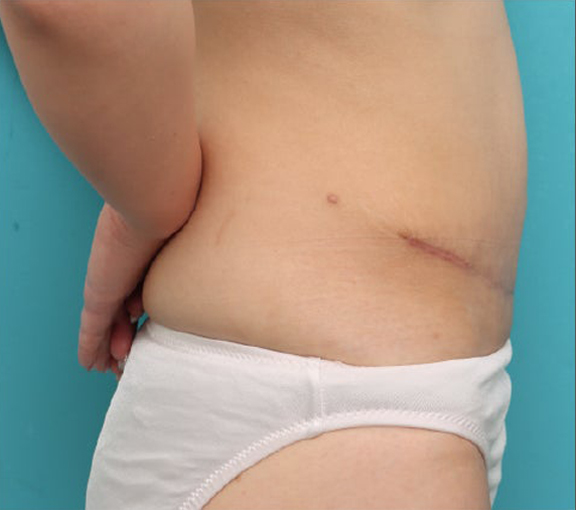 症例写真,腹リダクション（お腹のたるみ取り）手術で妊娠後のお腹のたるみを改善した20代女性の症例写真,After（6ヶ月後）,ba_hara003_b03.jpg