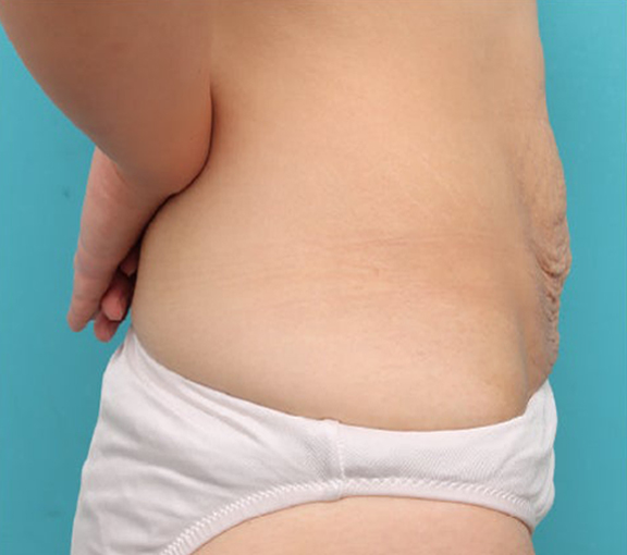 症例写真,腹リダクション（お腹のたるみ取り）手術で妊娠後のお腹のたるみを改善した20代女性の症例写真,Before,ba_hara003_b03.jpg