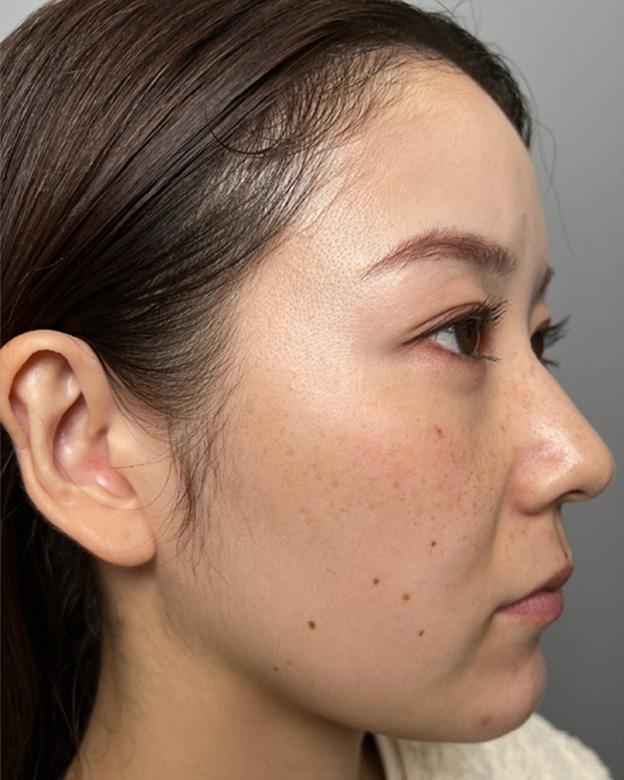 うる肌注射（ボライトXC）,肌に潤いを与えるボライトXC（うる肌注射）を行った症例写真,Before,ba_uruhada_b01.jpg