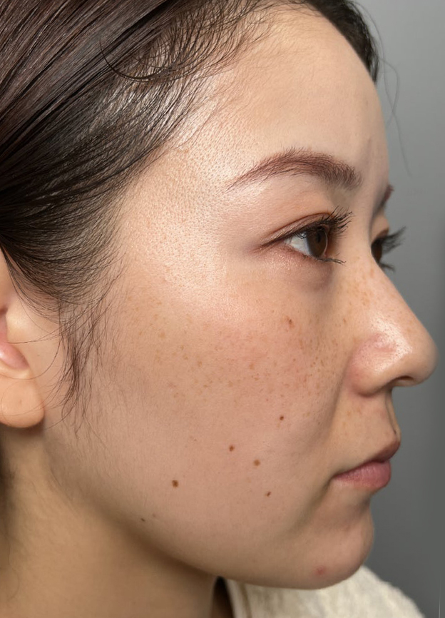 症例写真,肌に潤いを与えるボライトXC（うる肌注射）を行った症例写真,施術前,mainpic_uruhada001a.jpg