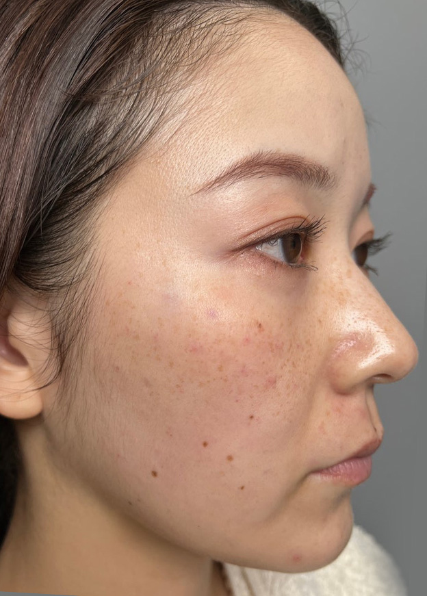 症例写真,肌に潤いを与えるボライトXC（うる肌注射）を行った症例写真,施術から30分後,mainpic_uruhada001c.jpg