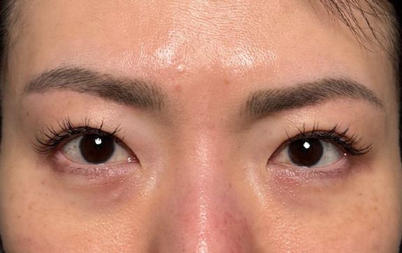眉下リフト（上眼瞼リフト）,眉下リフト（上眼瞼リフト）を行った40代の患者様の症例写真,After（6ヶ月後）,ba_jougankenlift018_a01.jpg