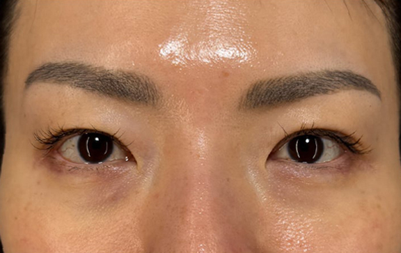 眉下リフト（上眼瞼リフト）,眉下リフト（上眼瞼リフト）を行った40代の患者様の症例写真,Before,ba_jougankenlift018_b01.jpg