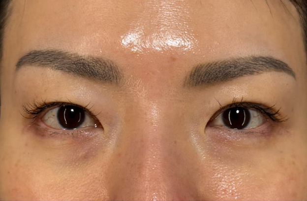 症例写真,眉下リフト（上眼瞼リフト）を行った40代の患者様の症例写真,施術前,mainpic_jougankenlift018a.jpg