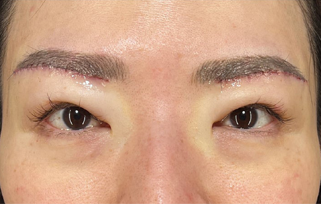 症例写真,眉下リフト（上眼瞼リフト）を行った40代の患者様の症例写真,施術直後,mainpic_jougankenlift018b.jpg