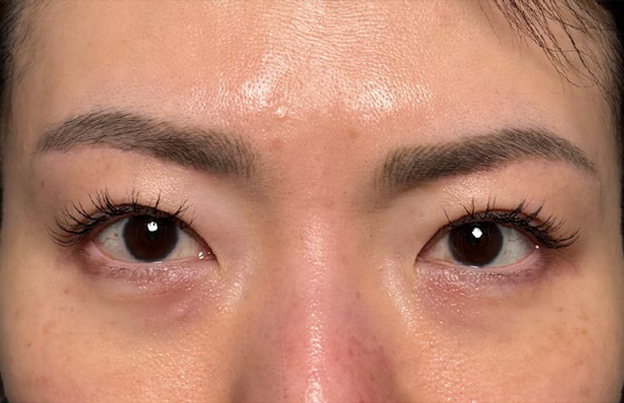 症例写真,眉下リフト（上眼瞼リフト）を行った40代の患者様の症例写真,6ヶ月後,mainpic_jougankenlift018c.jpg