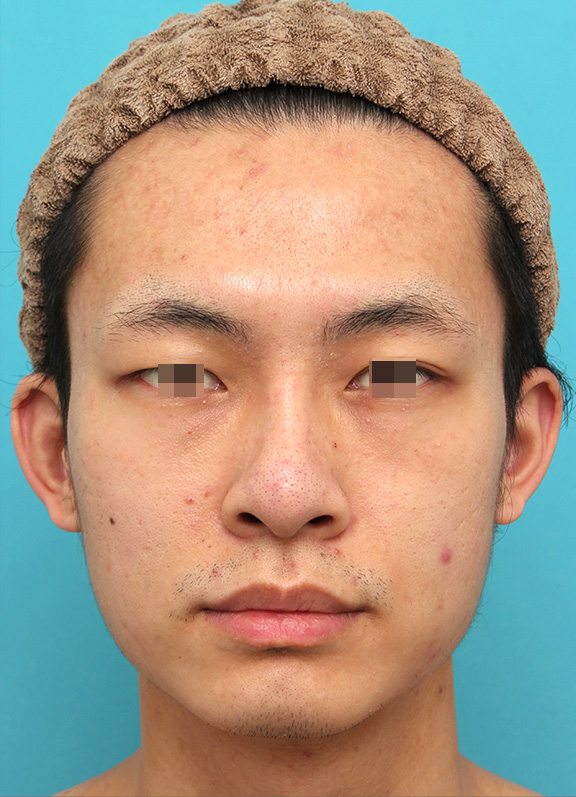 隆鼻術（シリコンプロテーゼ）,鼻プロテーゼを入れた後、もっと高くするために入れ替えて、その後更に高くするために入れ替えた症例写真,After（6mmの鼻シリコンプロテーゼを入れて6ヶ月後）,ba_ryubi1068_a01.jpg