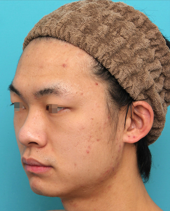 症例写真,鼻プロテーゼを入れた後、もっと高くするために入れ替えて、その後更に高くするために入れ替えた症例写真,Before,ba_ryubi1068_b02.jpg