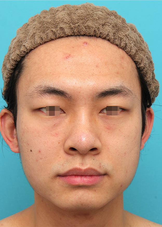 症例写真,鼻プロテーゼを入れた後、もっと高くするために入れ替えて、その後更に高くするために入れ替えた症例写真,3ヶ月後,mainpic_ryubi1068b.jpg