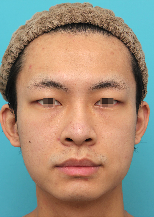 症例写真,鼻プロテーゼを入れた後、もっと高くするために入れ替えて、その後更に高くするために入れ替えた症例写真,2回目の手術後6ヶ月,mainpic_ryubi1068c.jpg