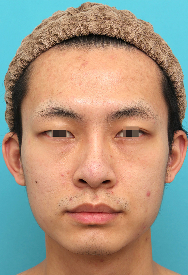 症例写真,鼻プロテーゼを入れた後、もっと高くするために入れ替えて、その後更に高くするために入れ替えた症例写真,3回目の手術後6ヶ月,mainpic_ryubi1068d.jpg