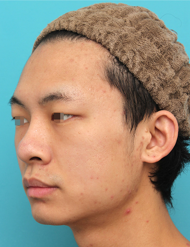症例写真,鼻プロテーゼを入れた後、もっと高くするために入れ替えて、その後更に高くするために入れ替えた症例写真,2回目の手術後6ヶ月,mainpic_ryubi1068g.jpg