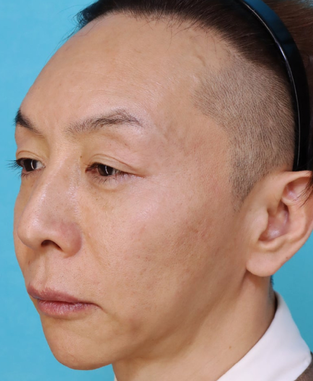 こめかみ・頬のこけ・フェイスライン・目元のくぼみにヒアルロン酸注入を行った男性の症例写真,After（2ヶ月後）,ba_kubomi015_a01.jpg