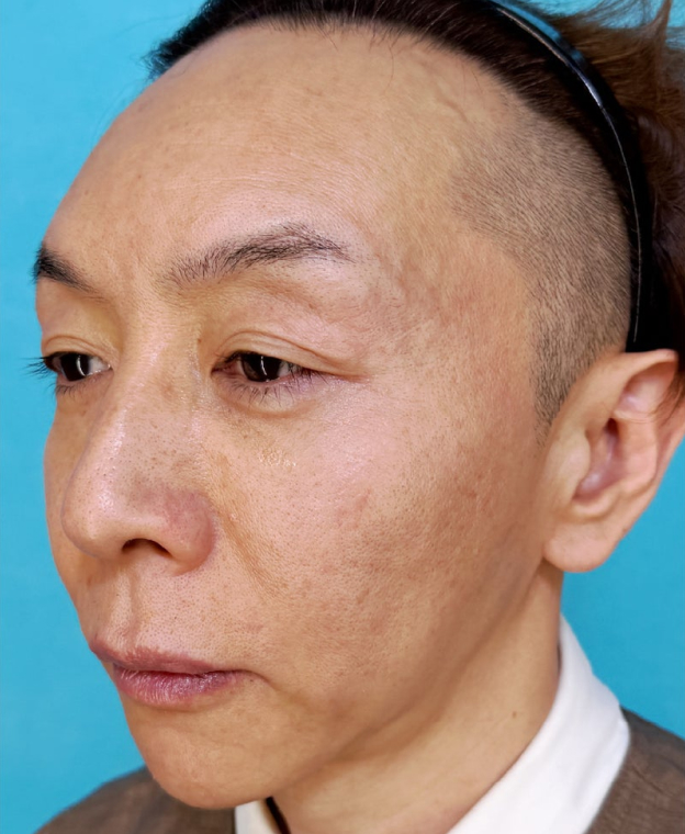 こめかみ・頬のこけ・フェイスライン・目元のくぼみにヒアルロン酸注入を行った男性の症例写真,Before,ba_kubomi015_b01.jpg